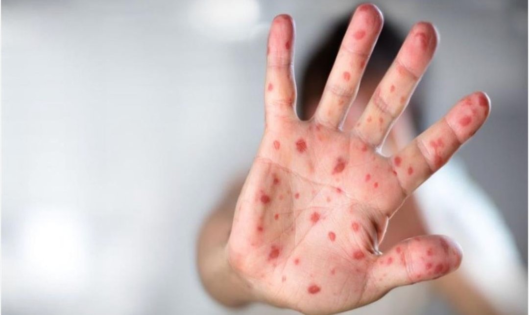 بالارقام وزير الصحة يكشف عن عدد حالات بوحمرون المسجلة بالمغرب