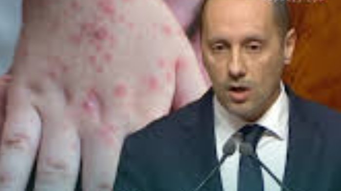 وزارة الصحة تعلن  عن تسجيل ارتفاع ملحوظ في حالات الإصابة بمرض الحصبة “بوحمرون”