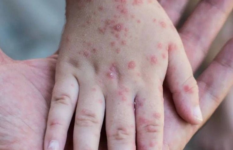 حالتي وفاة جديدة بسبب داء الحصبة “بوحمرون” بجهة طنجة تطوان الحسيمة